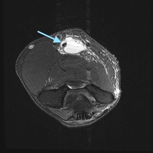 Figure 2 for case Rupture of bi-fid distal biceps tendon